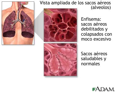 Enfermedad pulmonar obstructiva crónica